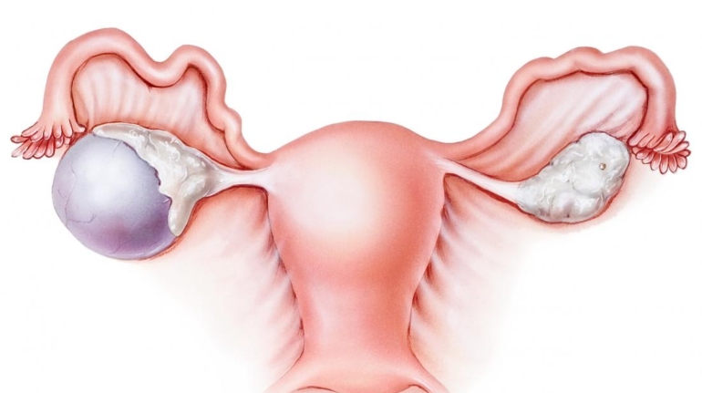 Yumurtalık Kisti Tedavisi Nedir?