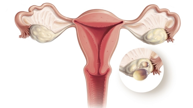 Kadınlarda Yumurtalık Kisti Nedir?