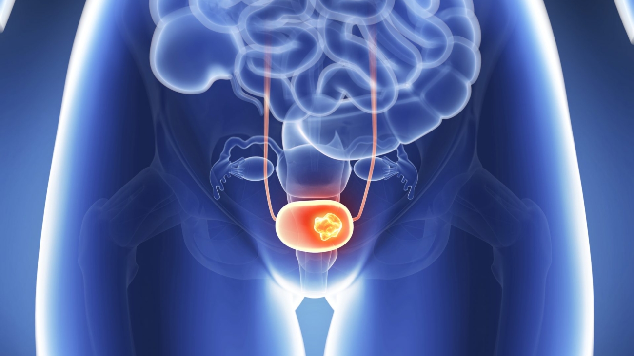 Rahim Ağzı Kanseri