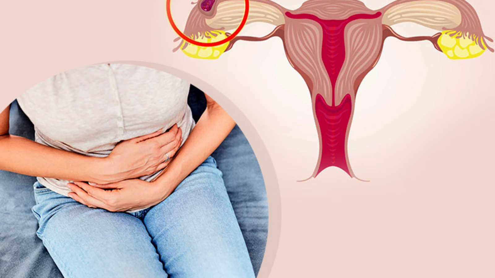 Dış Gebelik Nedenleri Belirtileri ve Tedavi Yöntemleri