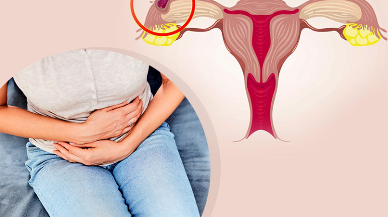 Dış Gebelik Nedenleri Belirtileri ve Tedavi Yöntemleri