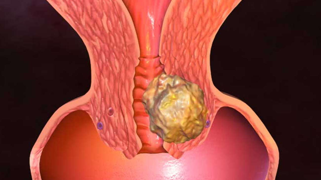 Rahim Ağzı İltihabı