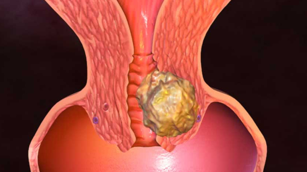 Rahim Ağzı İltihabı