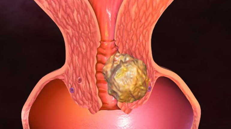 Rahim Ağzı İltihabı