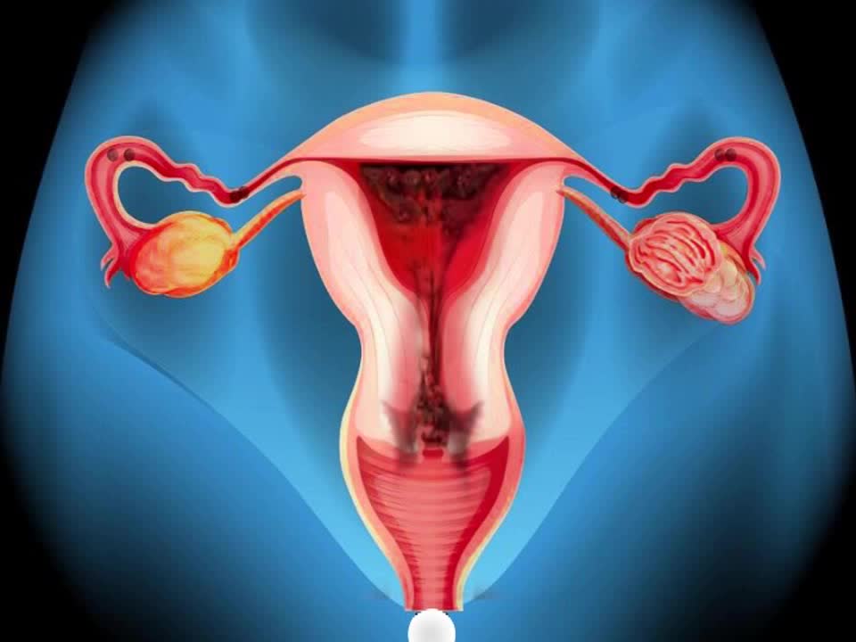 Serviks Kanseri Nedir?