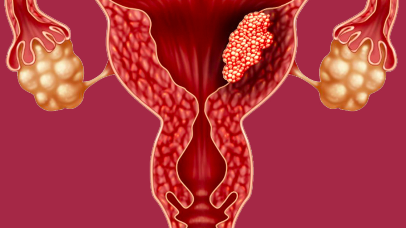 Endometrium Kanseri